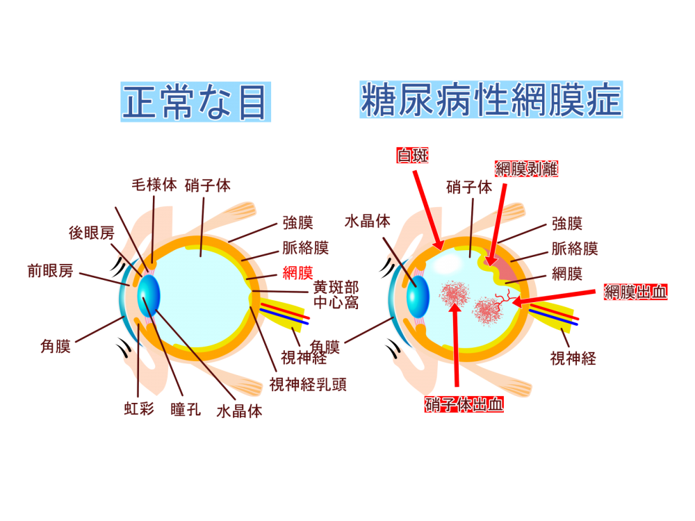 糖尿病網膜症