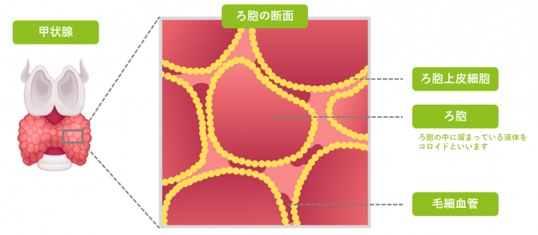 無痛性甲状腺炎